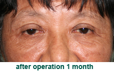 plastic-surgery-blepharoplasty